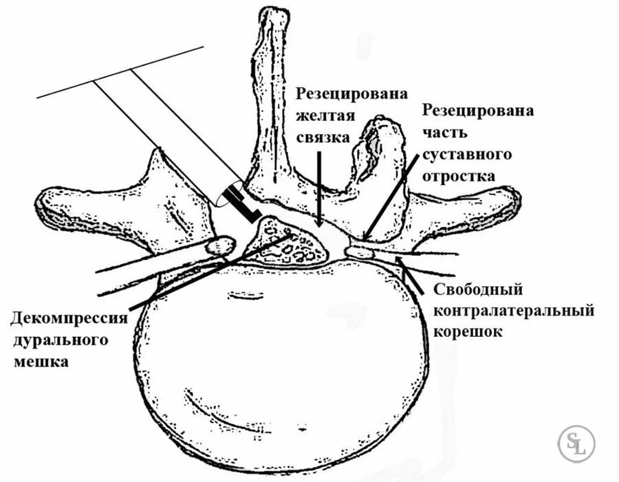 Спинальный стеноз операция. Дуральный мешок позвоночника шейного отдела. Дуральный мешок спинного мозга. Передняя стенка дурального мешка позвоночника что это. Деформация дурального мешка поясничного отдела позвоночника.