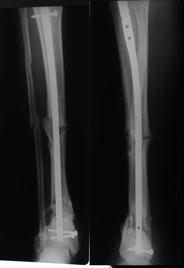 перелом большеберцовой кости рентген. перелом большеберцовой кости клиника. перелом большеберцовой кости рентген. перелом наружной части стопы. перелом диафиза большеберцовой.