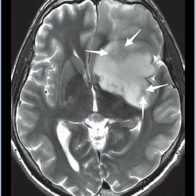 Анапластическая астроцитома кт. Астроцитома 4 Grey. Злокачественная астроцитома. Диффузная астроцитома