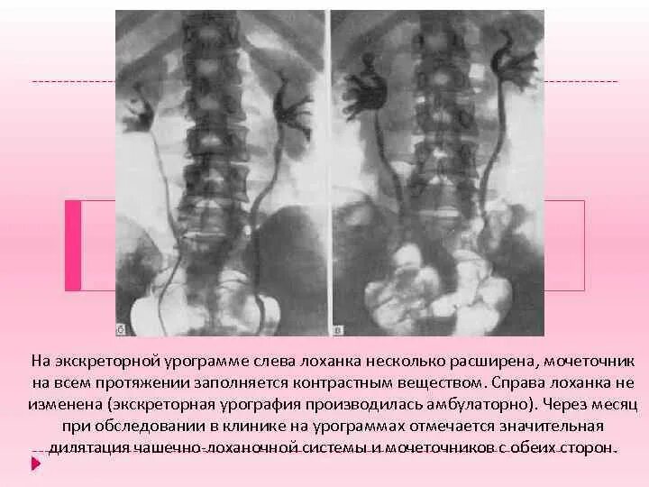 Мочеточник слева. Экскреторная урография камни в почках. Нефрофаза экскреторная урография. Губчатая почка выделительная урография.