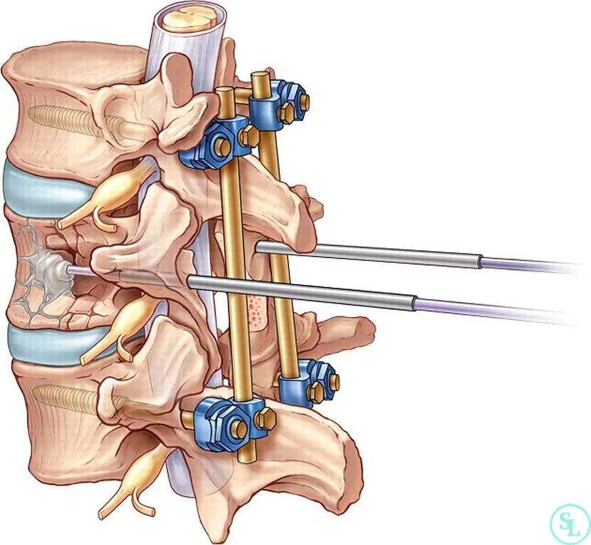 Транспедикулярная фиксация поясничного отдела. Ламинэктомия поясничного отдела. Ламинэктомия позвоночника. Операция ламинэктомия. Конструкция позвоночника операция