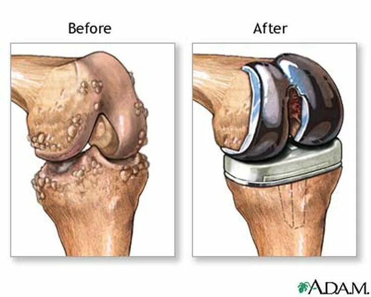 Гонартроз эндопротезирование коленного сустава. Артроз коленного сустава эндопротез. Артропластика коленного сустава. Протез коленного сустава.