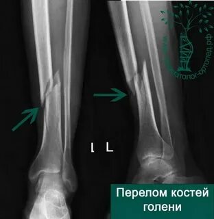 Закрытый перелом кости без смещения мкб
