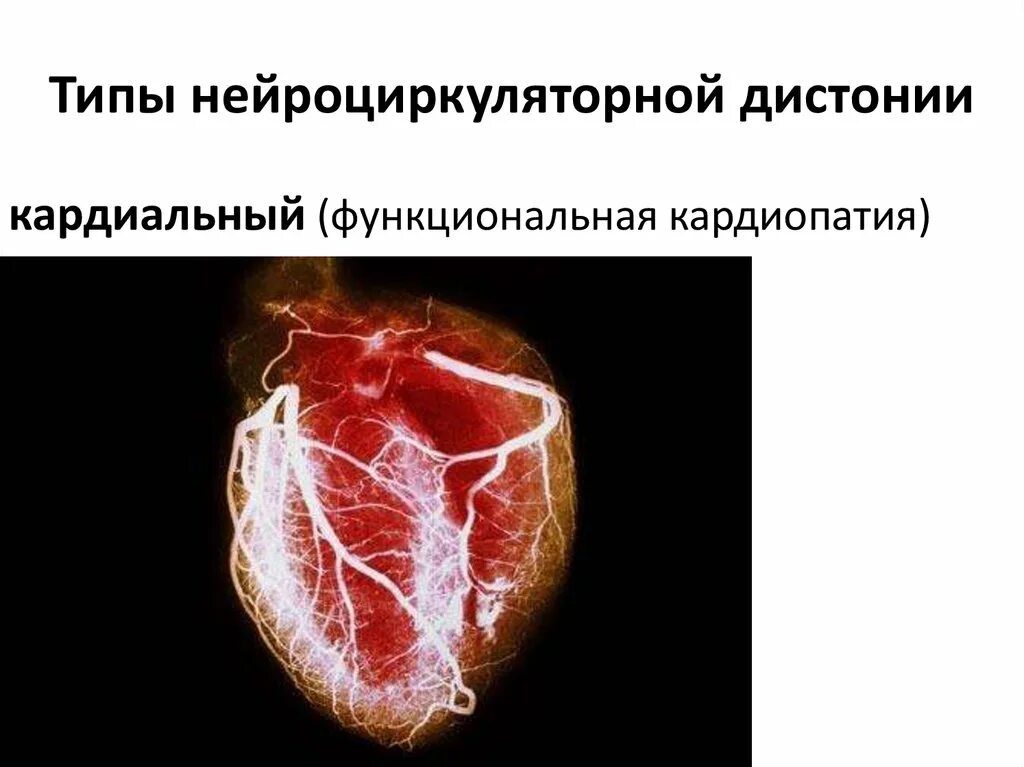 Всд. Заболевания вегето сосудистой системы. Вигетасосудистая дистония. Типы нейроциркуляторной дистонии. Всд сердце.