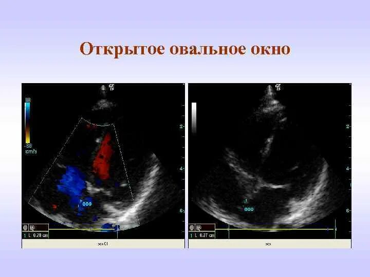 Где находится овальное окно. Открытое овальное окно на УЗИ У новорожденного. Открытое овальное окно в сердце у новорожденного 2мм. УЗИ сердца открытое овальное окно у грудничка. Открытое овальное окно на УЗИ сердца.