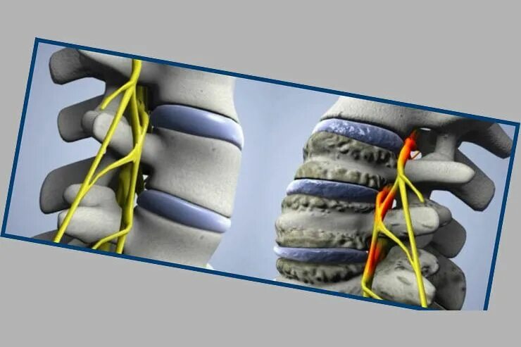 Унковертебральный артроз с3-с6. Межпозвонковая грыжа шейного отдела. Унковертебральный артроз 2ст. Межпозвонковая грыжа шейного отдела симптомы. Унковертебральный артроз 1-2.