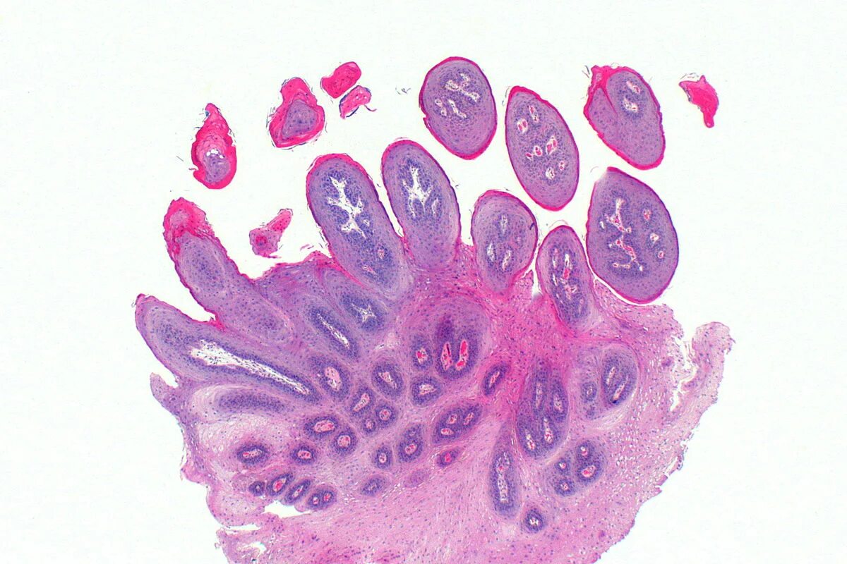 Плоскоклеточная папиллома полости рта гистология. Плоскоклеточная папиллома кожи микропрепарат. Плоскоклеточная папиллома микропрепарат. Остроконечная кондилома гистология. Рак головки члена