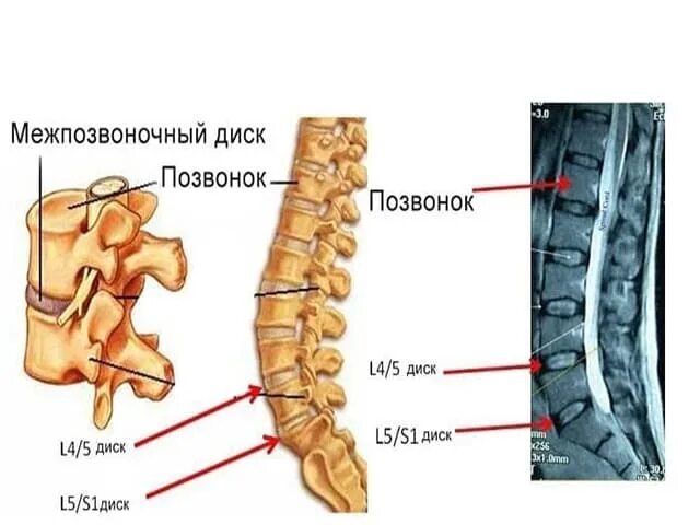 Грыжа диска l5 s1 что это