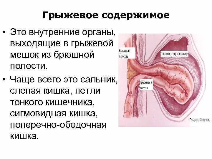 Что находится внутри грыжи Паховая грыжа Arimed