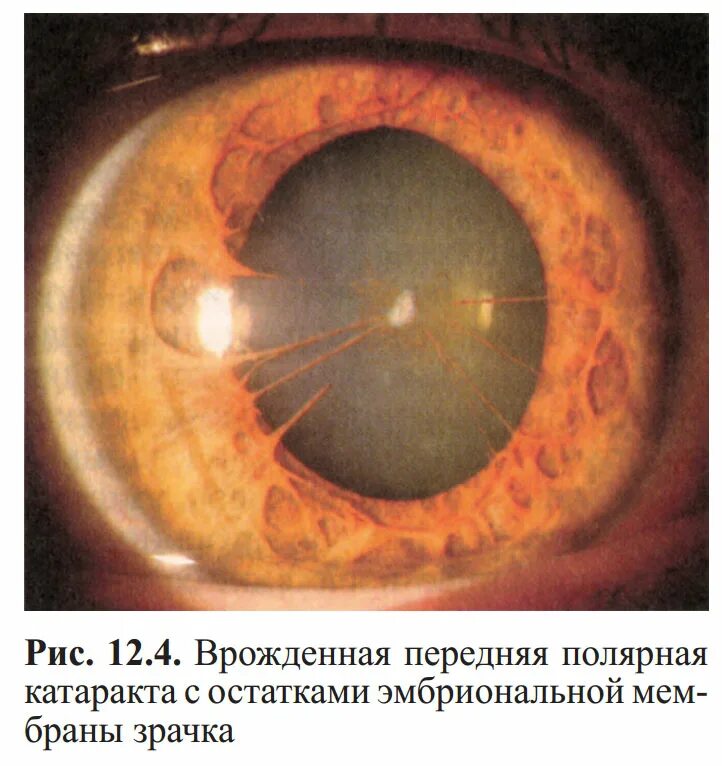 Катаракта биомикроскопия. Капсулярная врожденная катаракта. Биомикроскопия глаза хрусталик. Врожденная Полярная катаракта.