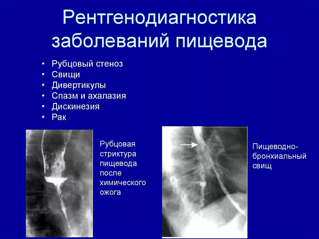 Рубцовые сужения пищевода