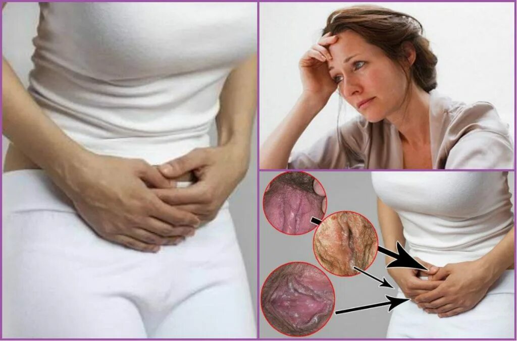 Кандидозы у женщин при беременности. Кандида у беременных. Молочница в 3 триместре беременности. Кандида у беременных. Чем опасна молочница при беременности.