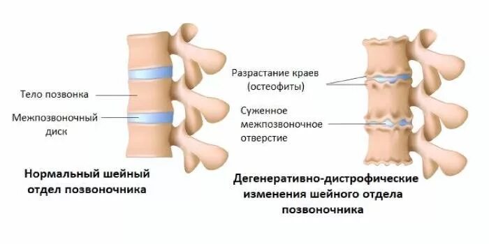 Диффузно дегенеративные. Дистрофические изменения шейного отдела позвоночника. Дегенеративно-дистрофические изменения шейные позвонки. Дугоотросчатые суставы позвоночника. Дегенеративные изменения грудного отдела позвоночника что это такое.