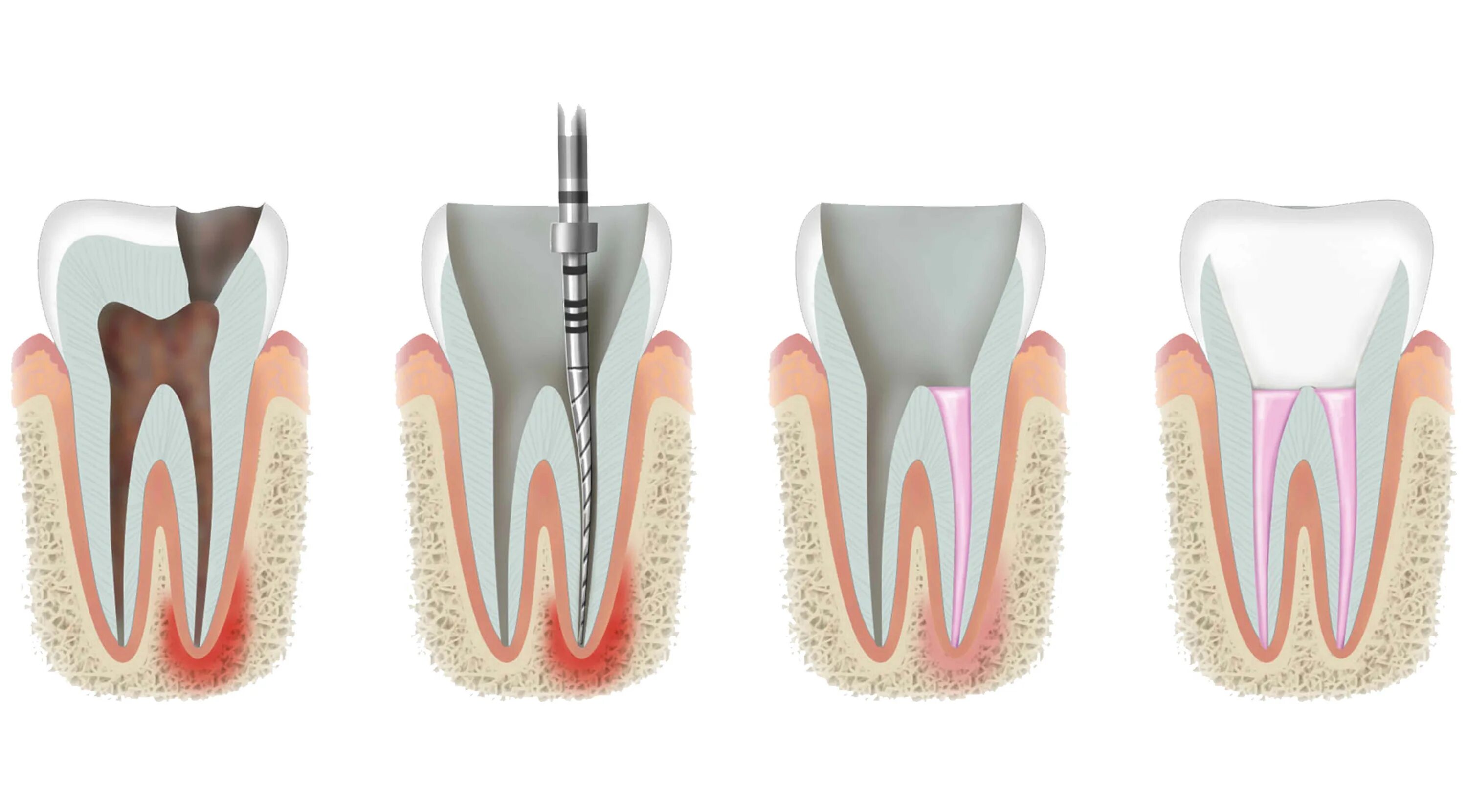 Периодонтит эндодонтия. Пломбирование зуба после лечения каналов