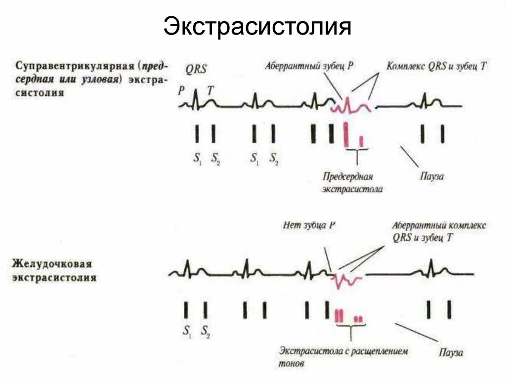 Аберрантные экстрасистолы на ЭКГ. Абберантные предсердные экстрасистолы ЭКГ. Аберрантный комплекс QRS на ЭКГ. Наджелудочковая экстрасистолия с аберрантным проведением на ЭКГ. Аберрантные экстрасистолы