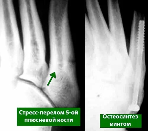 Стрессовый перелом 5 плюсневой кости. Авульсионный перелом 5 плюсневой кости. Субкапитальный перелом 4 плюсневой кости. Перелом 2 3 4 плюсневых костей.