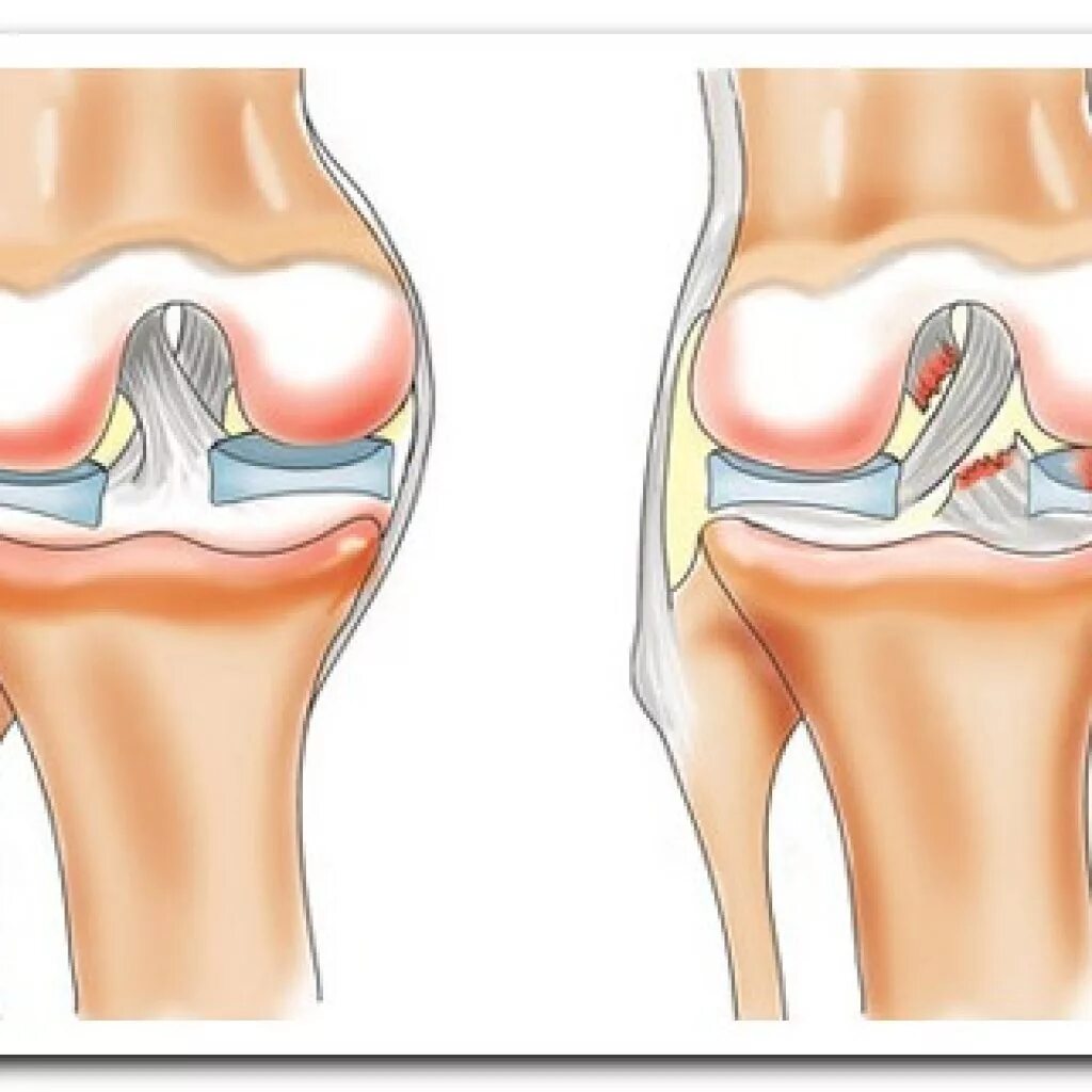 Связка мениска колена. Разрыв мениска коленного симптомы. Разрыв мениска коленного сустава. Растяжение мениска коленного сустава симптомы.