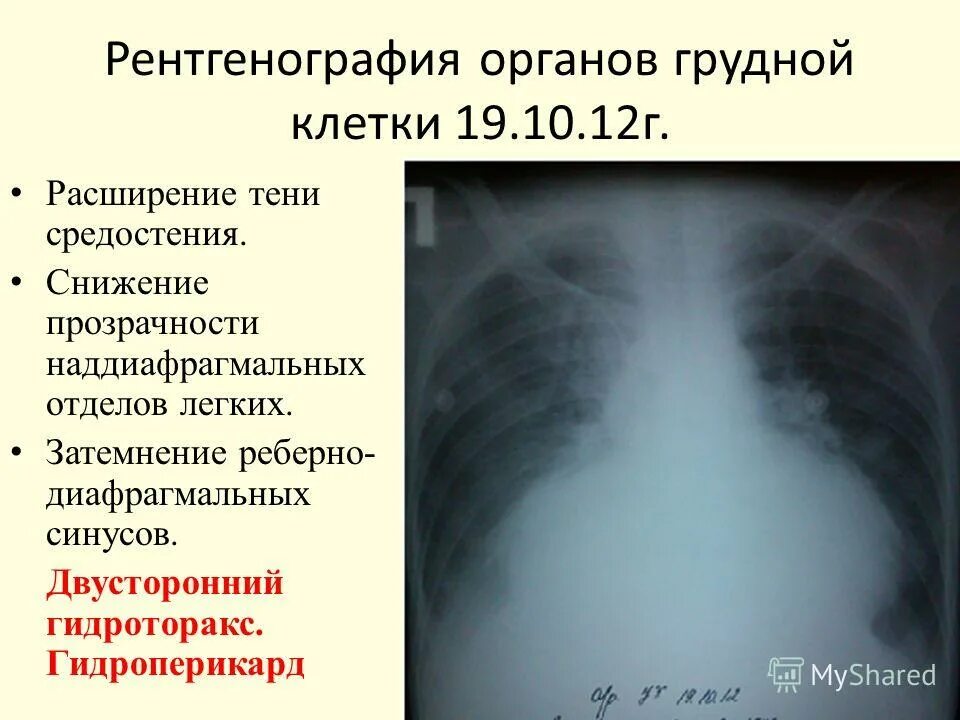 Снижение прозрачности. Рентгенография органов грудной клетки средостения. Снижение прозрачности пазух. Снижение прозрачности. Снижение прозрачности.