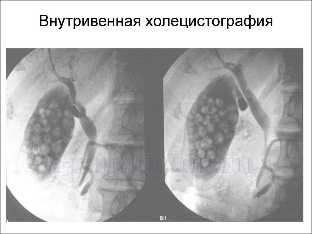 Желчекаменная болезнь холецистография. Холецистография это исследование. Ультразвуковая динамическая холецистография. Холецистография это исследование. Подготовка пациента к холецистографии.