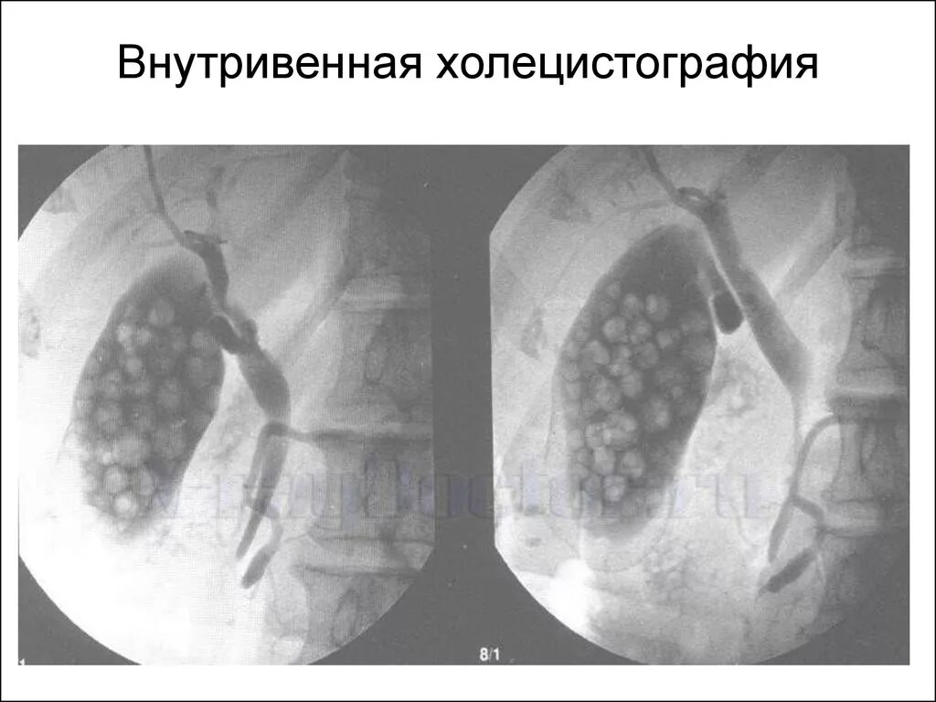 Пероральная холецистография. Желчекаменная болезнь холецистография. Внутривенная пероральная холецистография. Желчнокаменная болезнь рентген. Желчекаменная болезнь рентген.