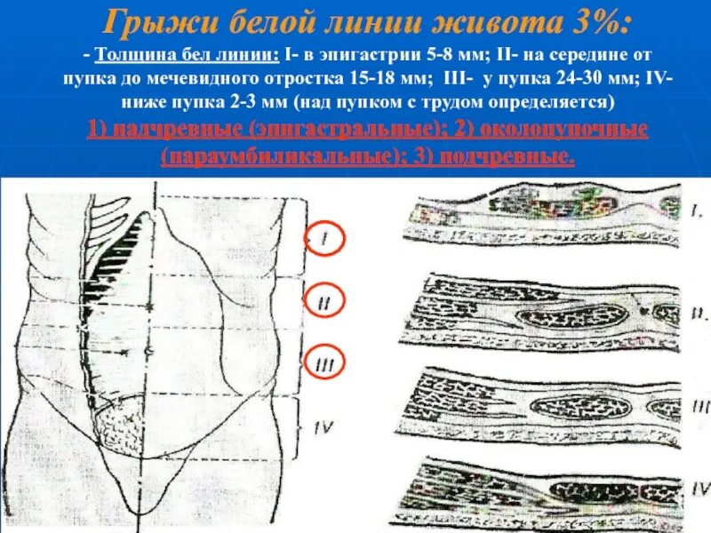 Слабые места передней брюшной стенки. Белая линия живота пупочное кольцо. Слои брюшной стенки топографическая анатомия. Топография пупочного кольца. Белая линия живота и пупочное кольцо.