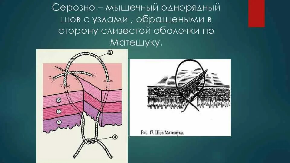 Шов пирогова. Шов мышцы. Шов мышцы. Шов мышцы. Шов мышцы.