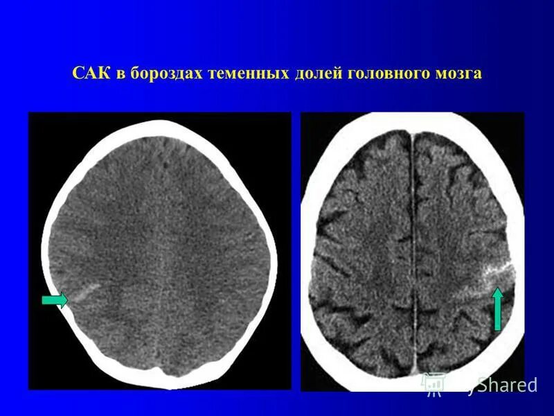 Борозды мозга на кт. Доли головного мозга на кт. Центральная борозда головного мозга на кт.