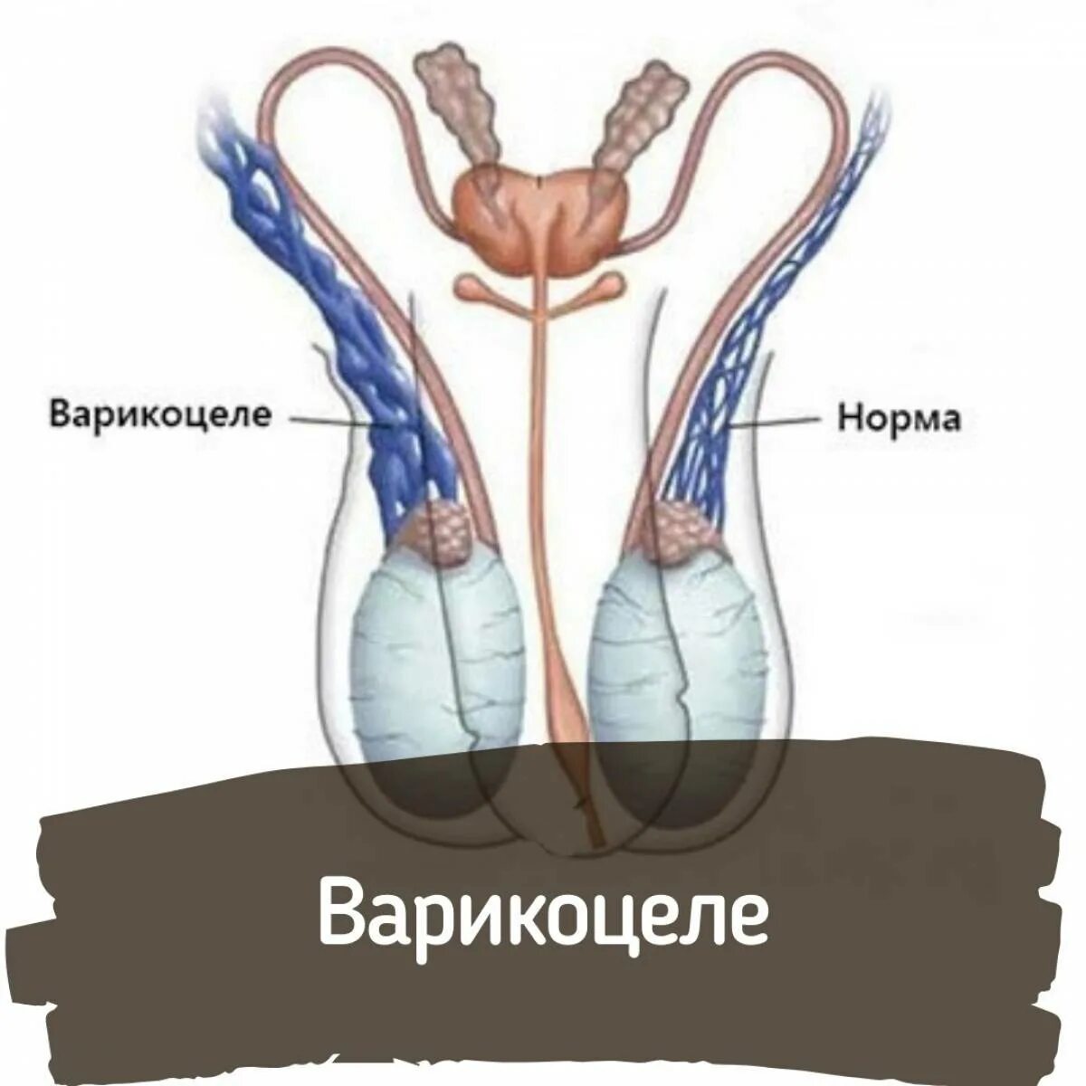 Варикоз вен семенного канатика. Варикоз сосудов семенного канатика. Расширение вен семенного канатика. Вена левого яичка