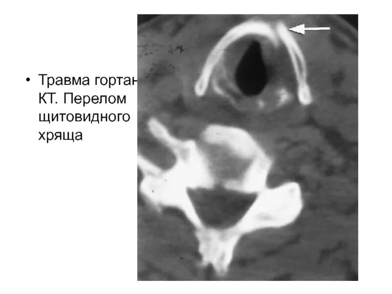 Обызвествление хрящей гортани на рентгене. Рентген лучезапястный сустав перелом лучевой кости. Наружной лодыжки большеберцовой кости эпифизеолиз. Оссификаты коленного сустава рентген. Хрящевой перелом.