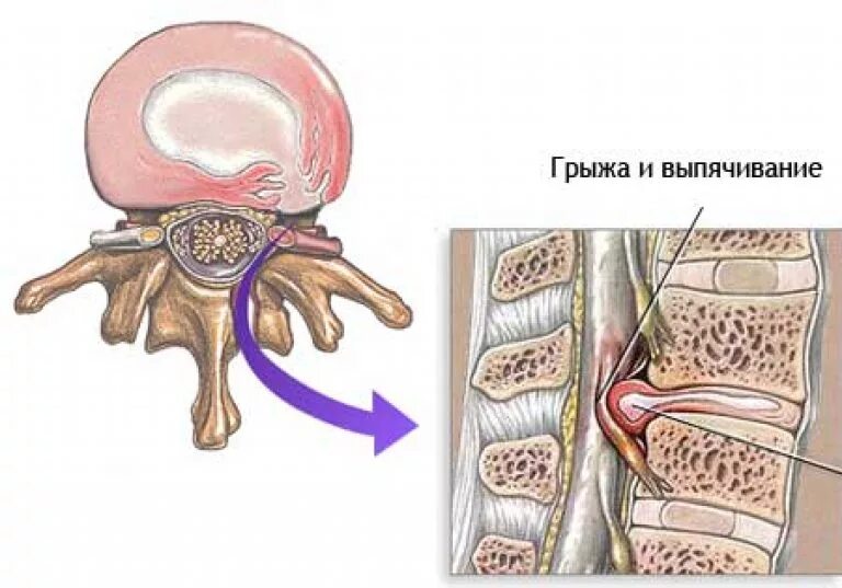 Грыжа поясничного отдела лечение у мужчин симптомы. Грыжа позвоночного отдела диска. Грыжа диска позвоночника поясничного отдела. Грыжа межпозвонкового диска шейного отдела. Межпозвоночная грыжа грыжа поясничного отдела.