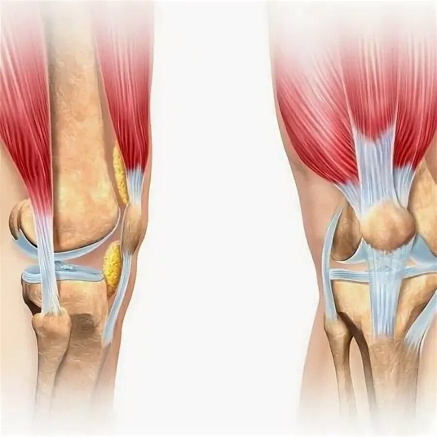 Лигаментоз крестообразных связок коленных. Лигаментоз крестовидных связок. Лигаментоз коленного сустава. Лигаментоз связок коленного сустава.
