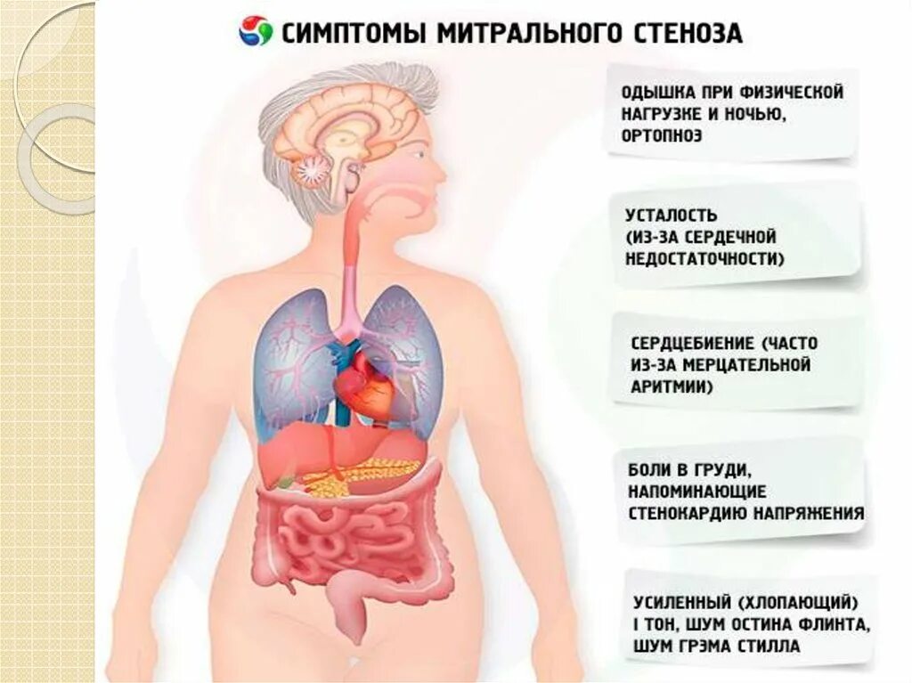 Стеноз митрального клапана симптомы. Клапанные признаки митрального стеноза. Митральный стеноз симптомы. Симптомы при митральном стенозе. Митральный стеноз признаки