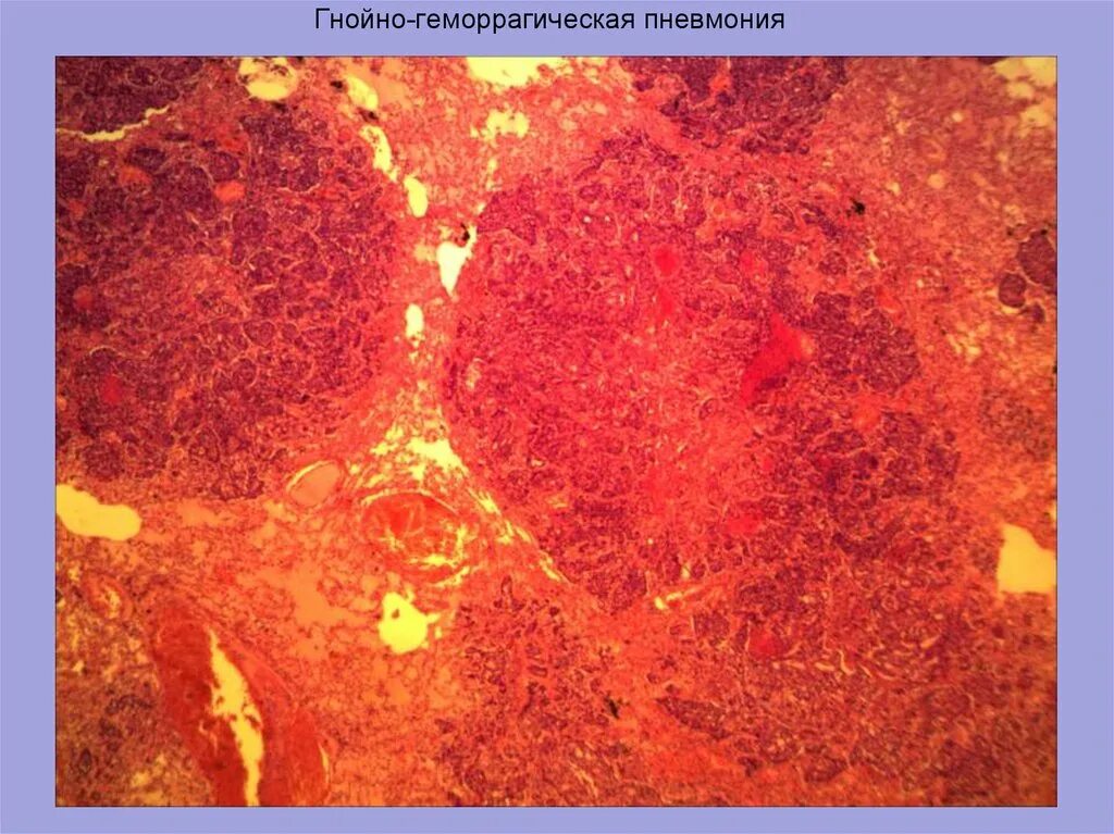 Геморрагическое воспаление патанатомия. Серозно геморрагическая пневмония. Фибринозно-геморрагическая пневмония. Геморрагическое воспаление макропрепарат.
