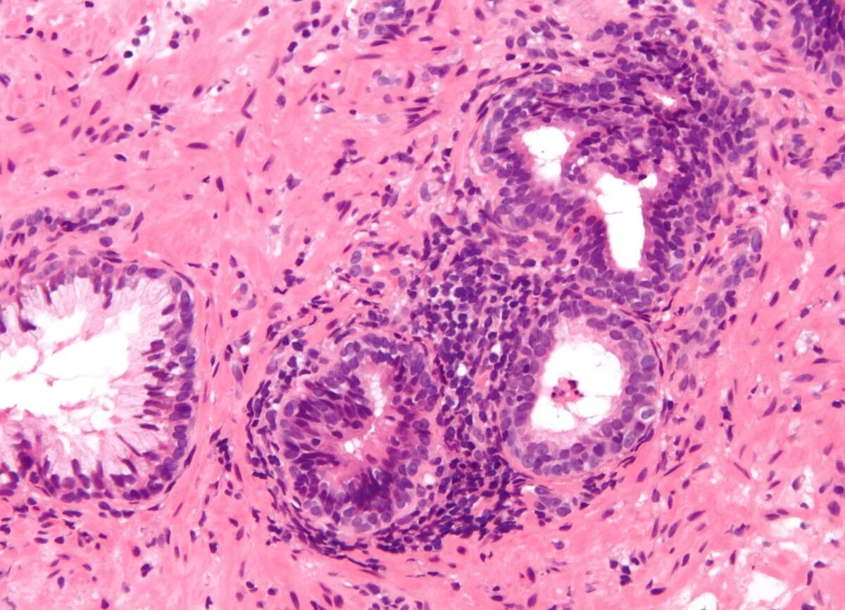 Хронический простатит гистология. Хронический простатит микропрепарат. Гранулематозный простатит гистология. Аденома предстательной железы микропрепарат. Ткань простаты