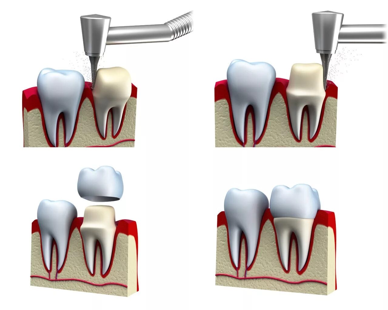 Микропротезы виниры вкладки стоматология. Металлокерамическая Штифтовая коронка. Депульпированный зуб на штифте. 3 зуба установить