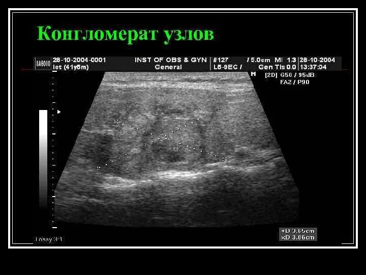 Щитовидная железа конгломерат узлов. Щитовидная железа конгломерат узлов