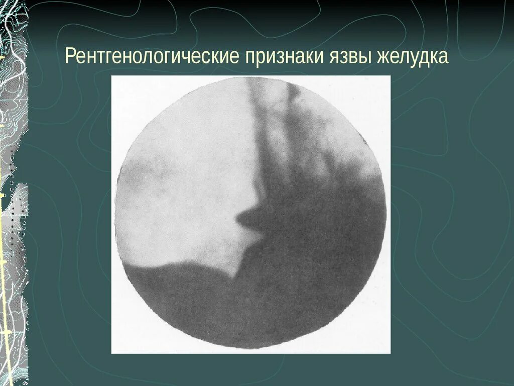 Перфорация язвы симптомы. Язва 12 перстной кишки рентген. Перфорация язвы желудка рентген. Рентгенологические признаки язвенной болезни. Рентгенологический критерий перфоративной язвы желудка.