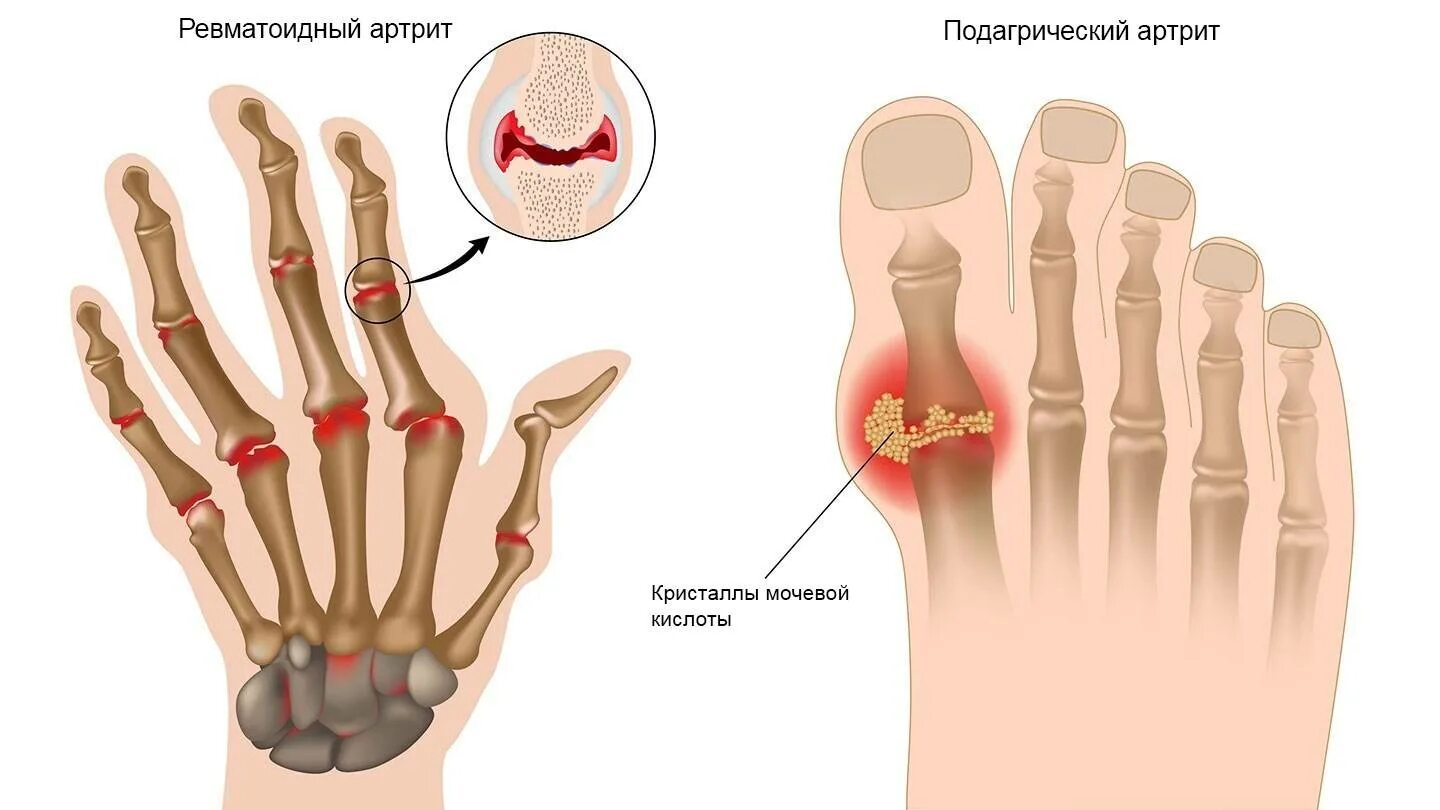 Ревматоидный артрит это. Ревматоидный артрит плюсна. Подагра поражение суставов. Псориатический артрит. Ревматоидный артрит полиартрит.