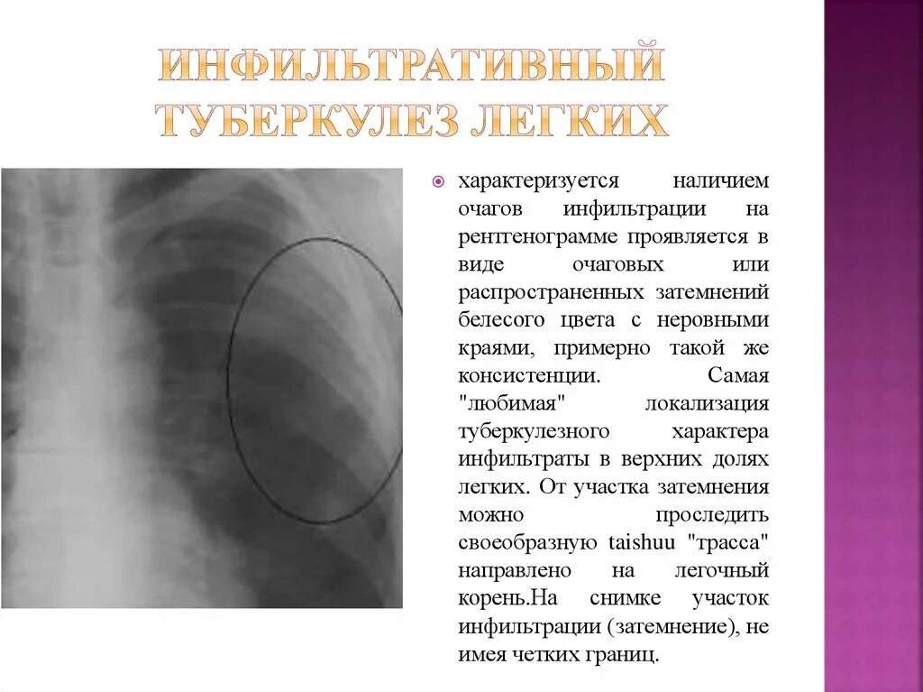 Инфильтративный туберкулез легких протокол рентген. Описание рентгенограммы инфильтративного туберкулеза. Очаговый туберкулез верхней доли правого легкого в фазе инфильтрации. Очаговый туберкулез инфильтративный туберкулез.