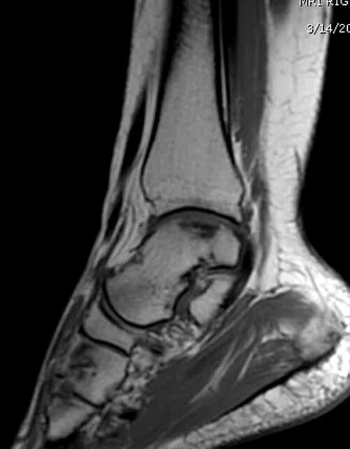остеонекроз таранной кости. асептический некроз таранной кости рентген. асептический некроз таранной кости мрт. асептический некроз кости голеностопного сустава. таранная кость асептический некроз.