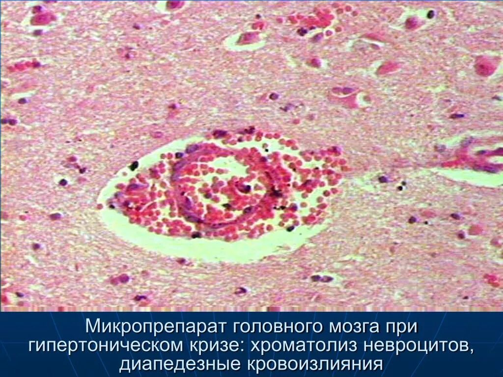 Глиобластома головного мозга гистология. Геморрагическое пропитывание мозга микропрепарат. Геморрагический инсульт макропрепарат. Венозное полнокровие микропрепарат. Синдром уотерхауса-фридериксена патанатомия.