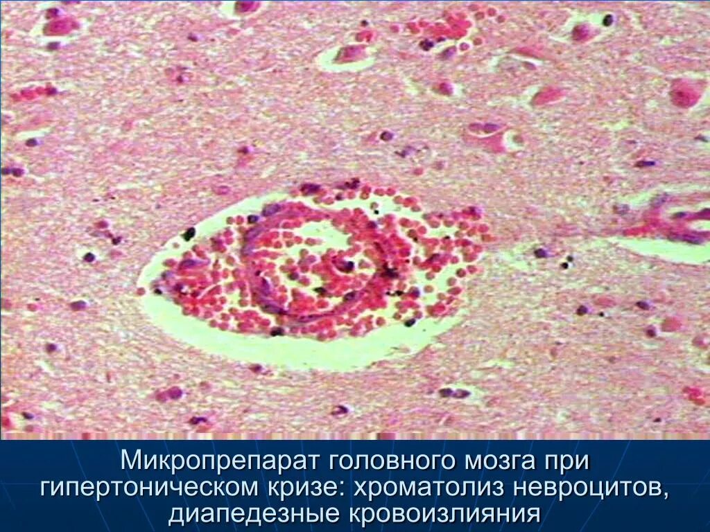 Микропрепарат головного мозга. Кровоизлияние в мозг микропрепарат патанатомия. Очаги кровоизлияний в головном мозге микропрепарат. Кровоизлияние в головной мозг микропрепарат патанатомия. Диапедезное кровоизлияние в мозг микропрепарат.