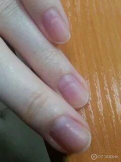 Пропили ногтей