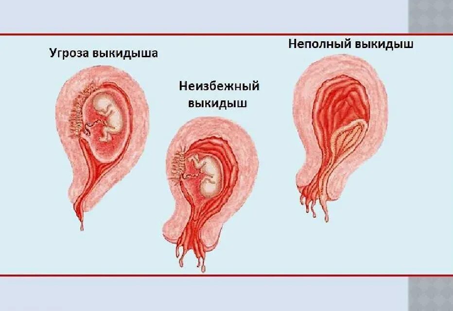 Выкидыш на наннем СПООКК. Самопроизвольный аборт.