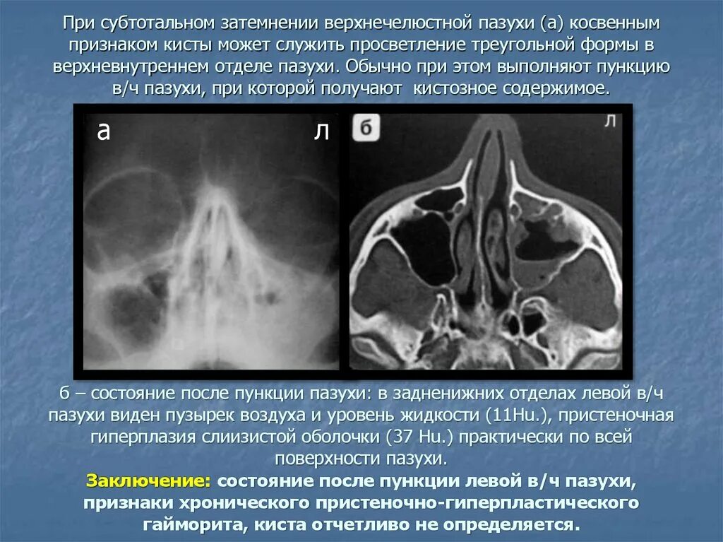 Пристеночное утолщение слизистой оболочки. Киста верхнечелюстной пазухи рентген описание. Киста левой левой верхнечелюстной пазухи. Субтотальное затемнение верхнечелюстных пазух рентген. Хронический синусит кт.