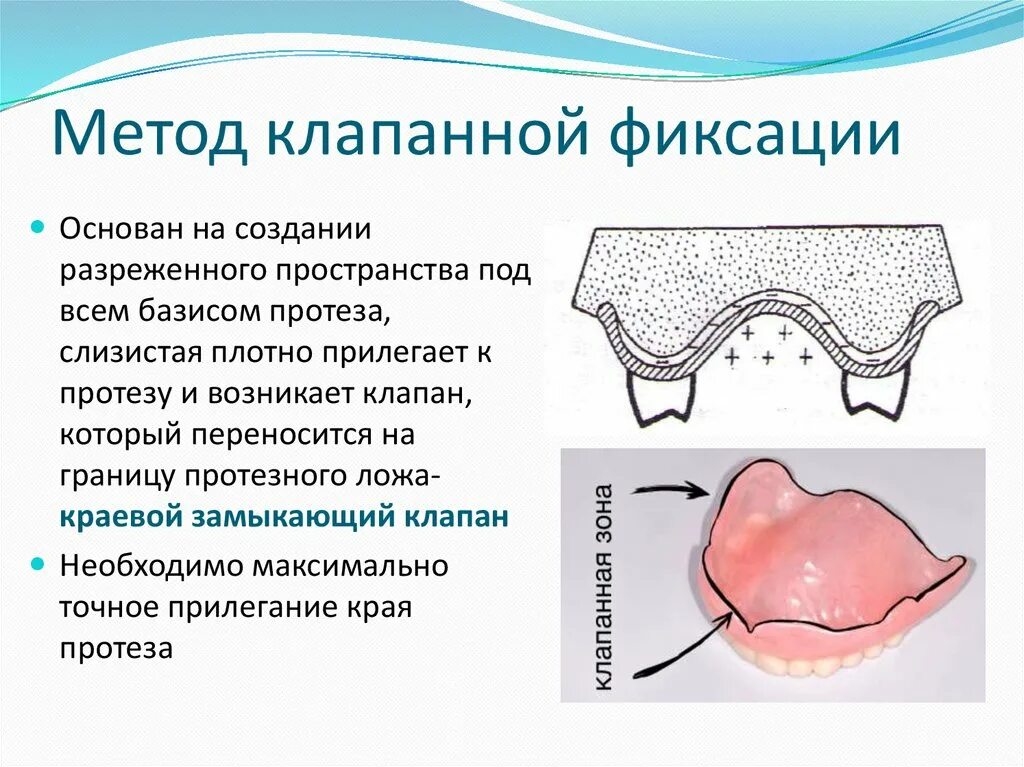 Границы пластиночного протеза. Методы фиксации и стабилизации съемных пластиночных протезов. Метод клапанной фиксации протеза. Краевой замыкающий клапан. Способы фиксации протезов на беззубых челюстях.