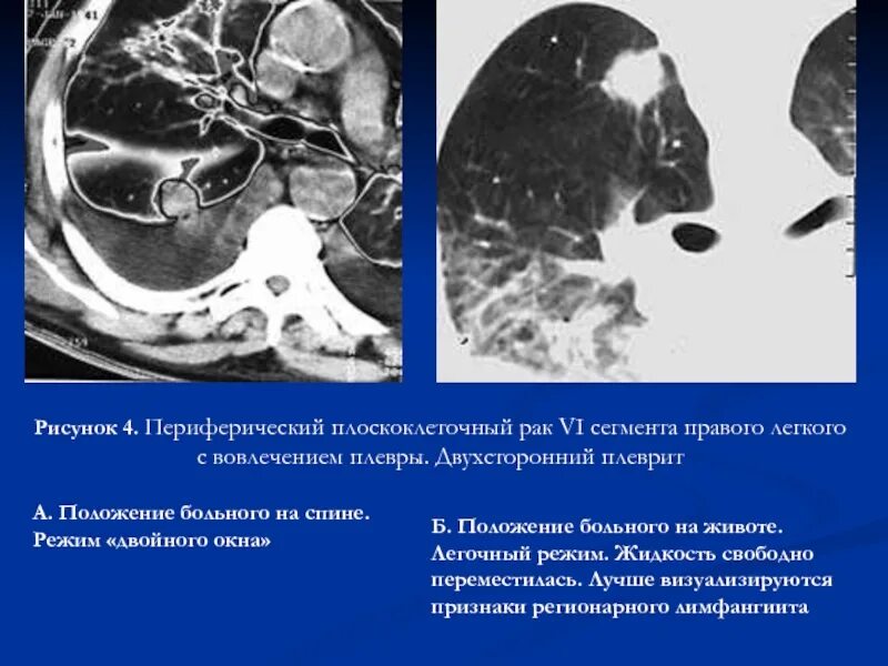 Плоскоклеточная карцинома легкого. )Плоскоклеточный опухоли легких. Плоскоклеточная карцинома легкого 3 стадия. Низкодифференцированная плоскоклеточная карцинома легкого. Стадии рака легких плоскоклеточный