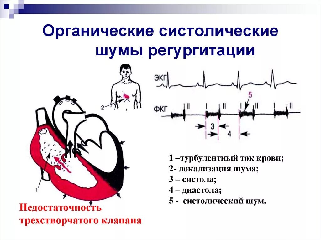 Органические систолические шумы ФКГ. Систолический шум функционального характера. Недостаточность митрального клапана аускультация. ЭКГ при недостаточности трехстворчатого клапана. Систолический шум это