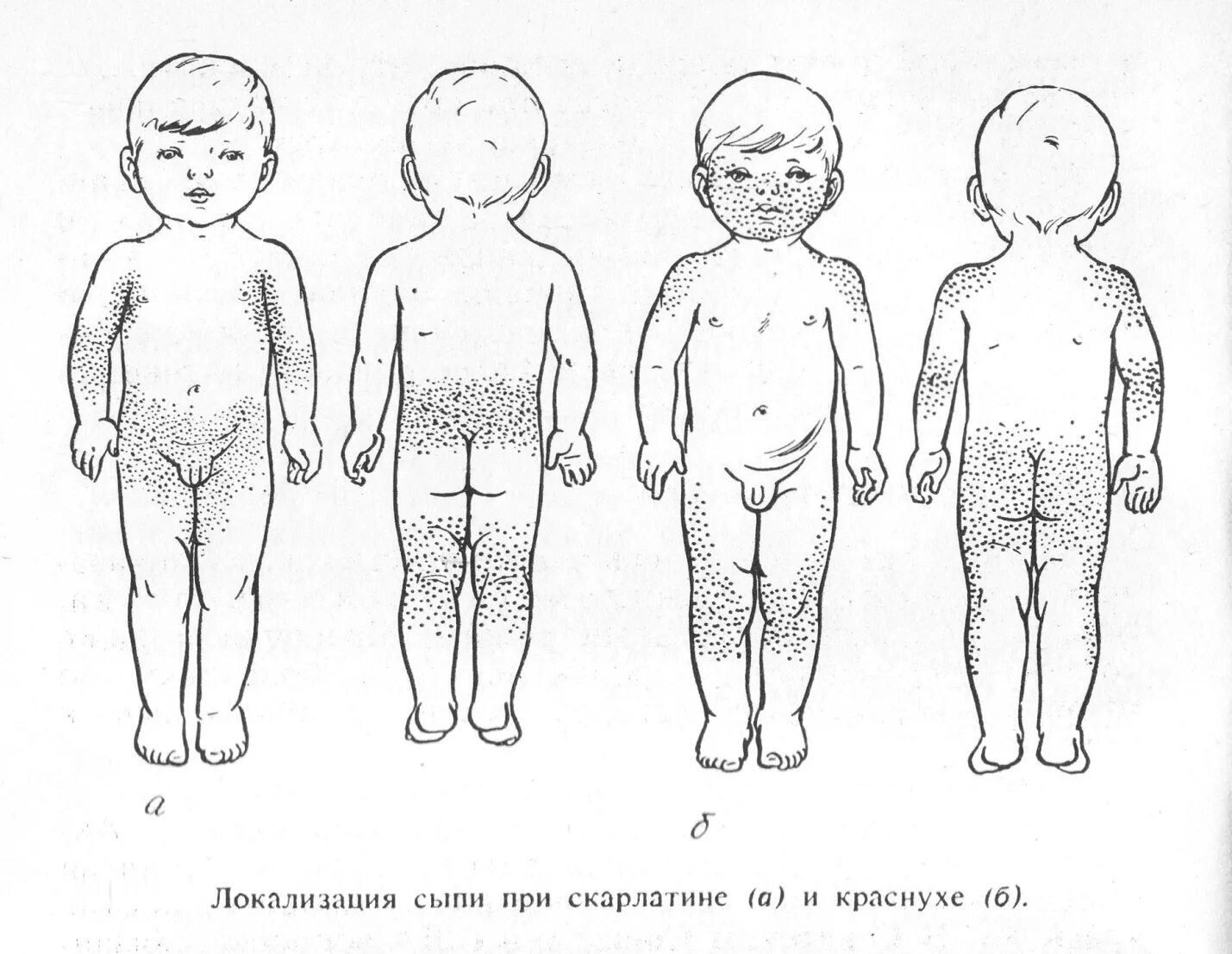 Корь краснуха скарлатина сыпь сыпь. Скарлатина локализация сыпи. Скарлатиноподобная экзантема. Сыпь отличия