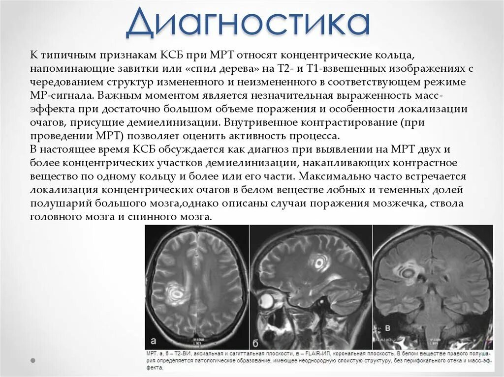 Прогрессирующая мультифокальная лейкоэнцефалопатия мрт. Мультифокальная лейкоэнцефалопатия кт. Лейкоэнцефалопатия головного мозга симптомы. Лейкоэнцефалопатия головного мозга кт. Поражение белого вещества мозга